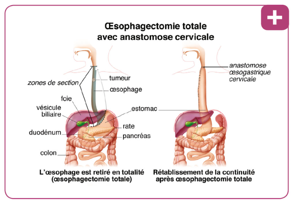 Cancer de l'œsophage – Chirurgie viscerale & digestive