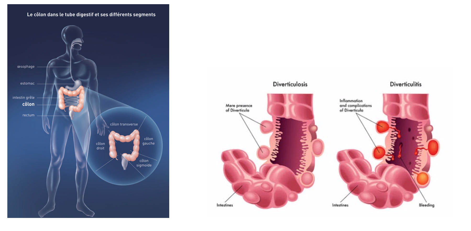 Diverticules – Chirurgie viscerale & digestive