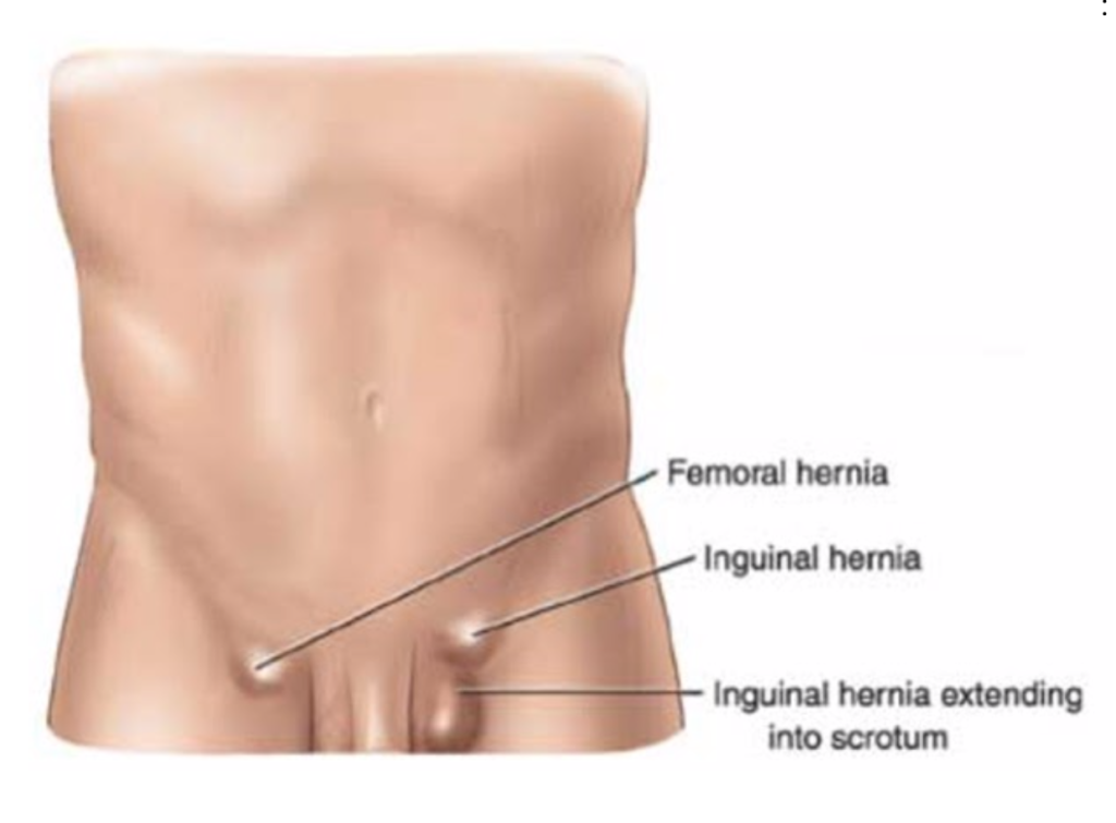Hernies inguinales – Chirurgie viscerale & digestive