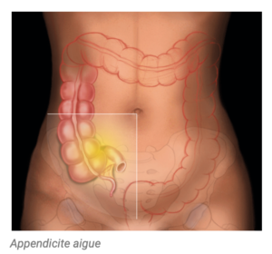 Appendicite – Chirurgie viscerale & digestive