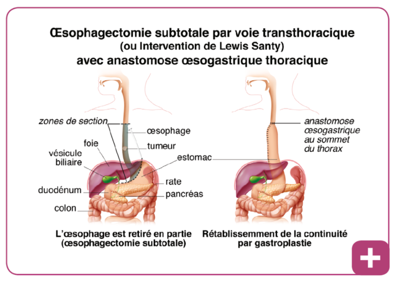 Cancer De L’œsophage – Chirurgie Viscerale & Digestive