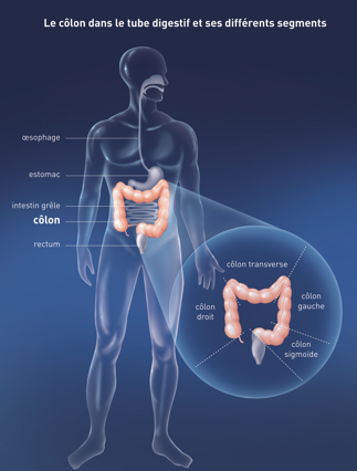 Cancer du côlon – Chirurgie viscerale & digestive
